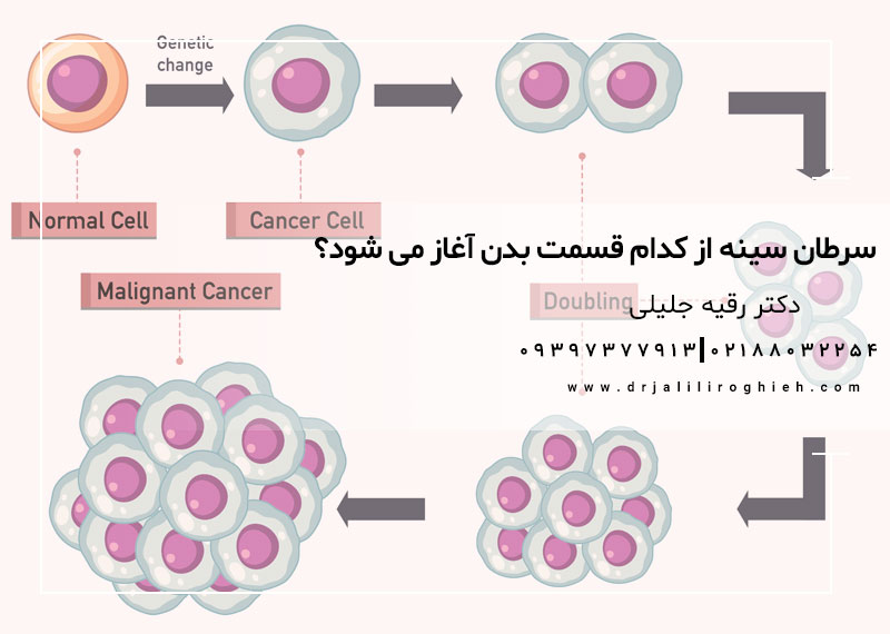 سرطان سینه (Breast Cancer) از کدام قسمت بدن آغاز می شود؟