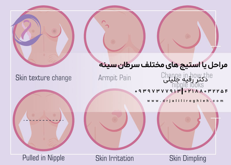 مراحل یا استیج های مختلف سرطان سینه