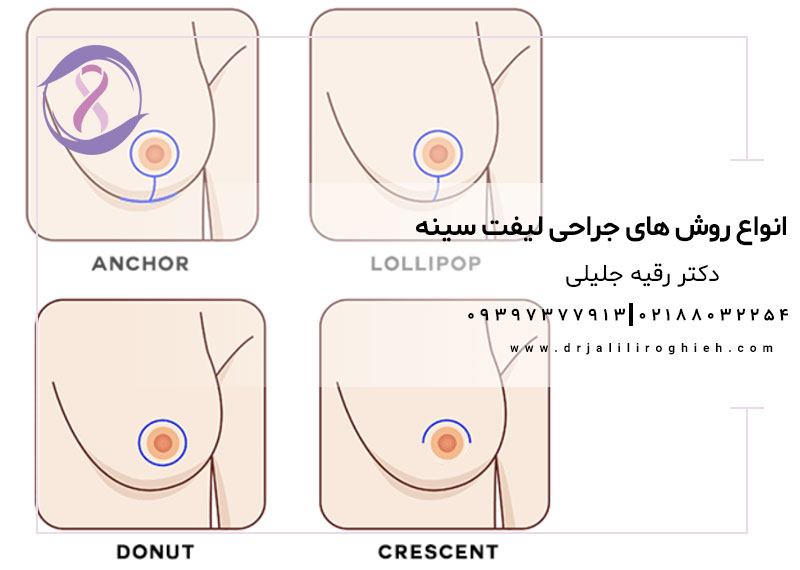 انواع روش های جراحی لیفت سینه
