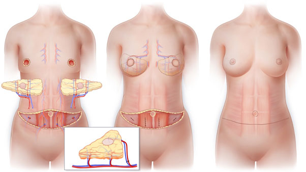 بازسازی از طریق بافت قسمت های دیگر بدن مثل چربی شکم