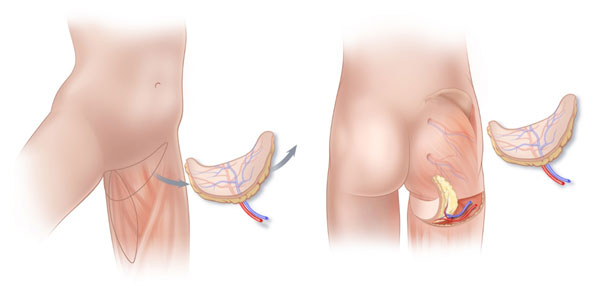 بازسازی از طریق فلپ رانی