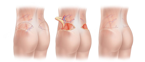 بازسازی سینه با استفاده از روش ترمیمی فلپ سرینی