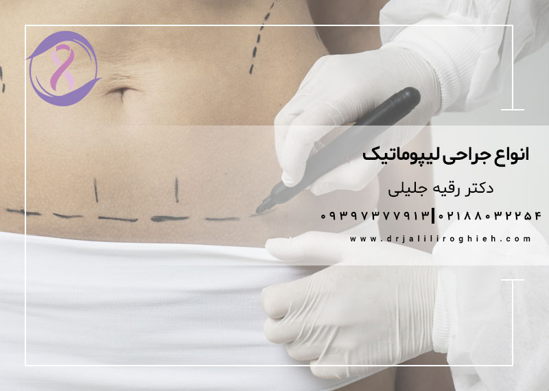 انواع جراحی لیپوماتیک