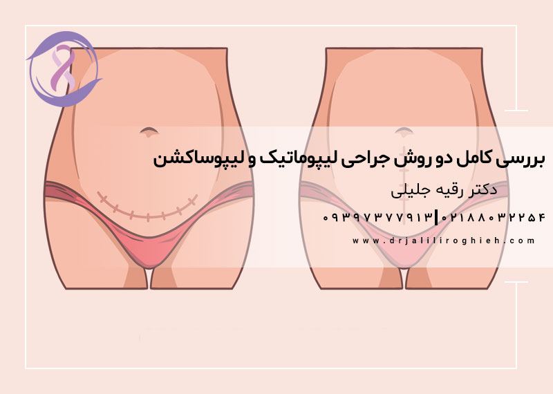 بررسی کامل دو روش جراحی لیپوماتیک و لیپوساکشن