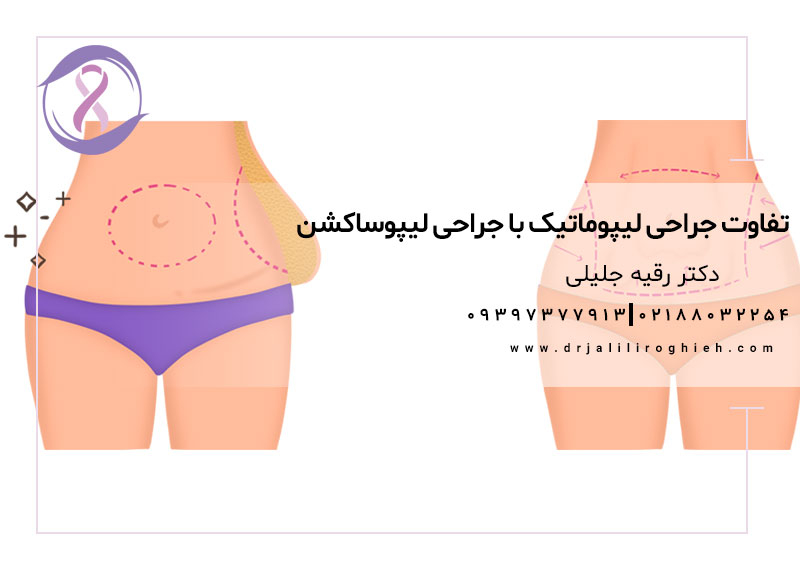 تفاوت جراحی لیپوماتیک با جراحی لیپوساکشن چیست؟