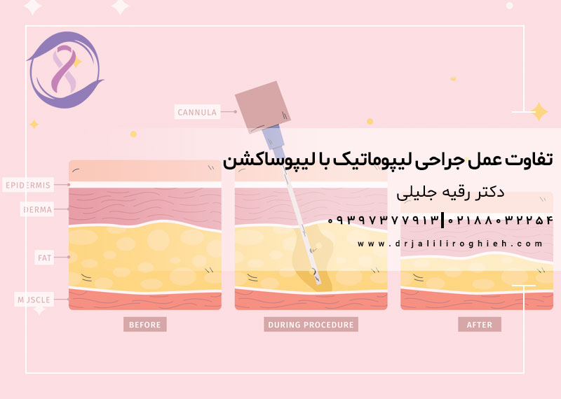 تفاوت عمل جراحی لیپوماتیک با لیپوساکشن
