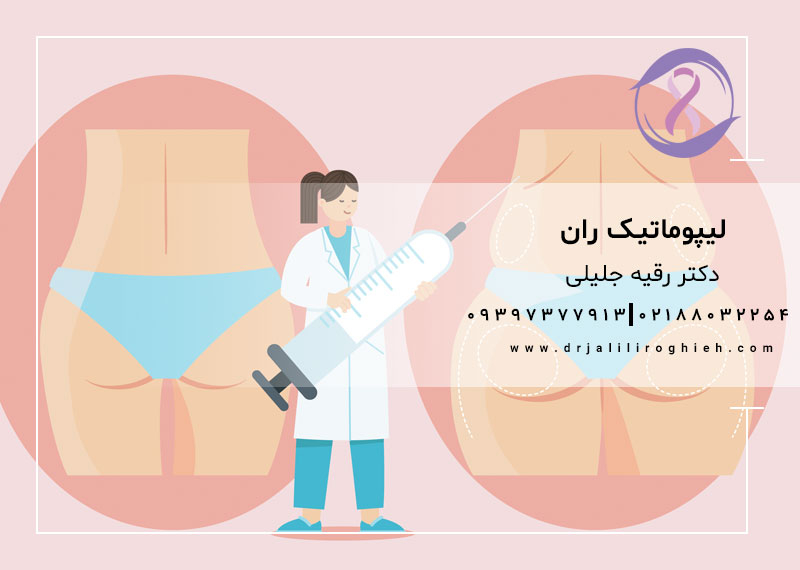 لیپوماتیک ران