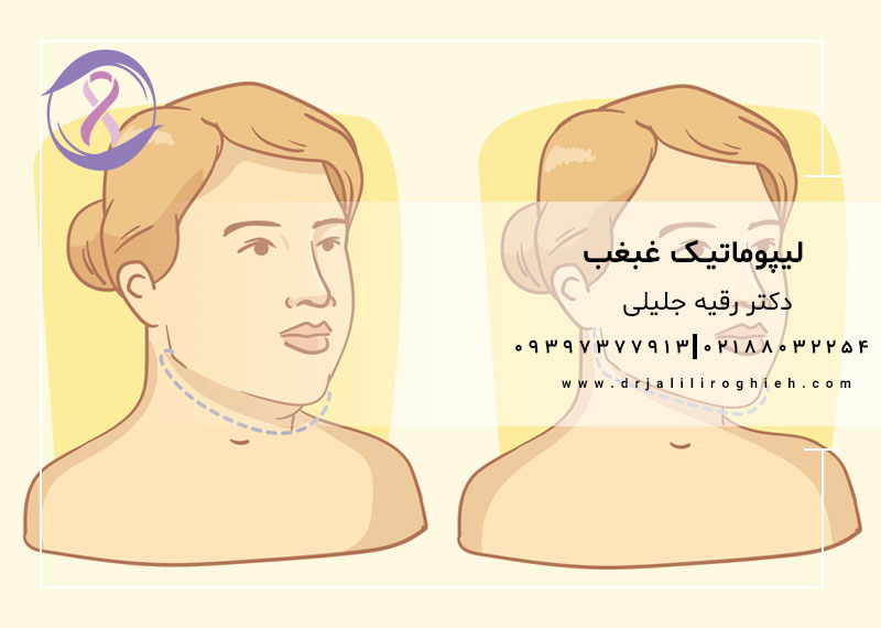 لیپوماتیک غبغب