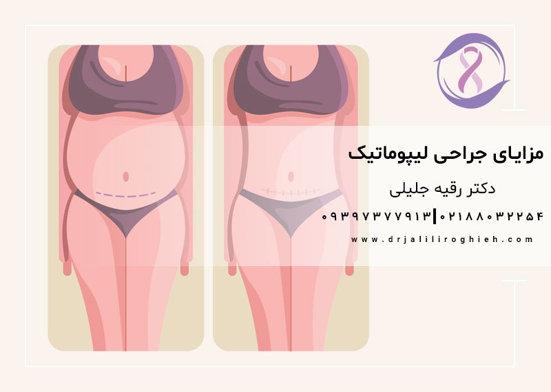 مزایای جراحی لیپوماتیک