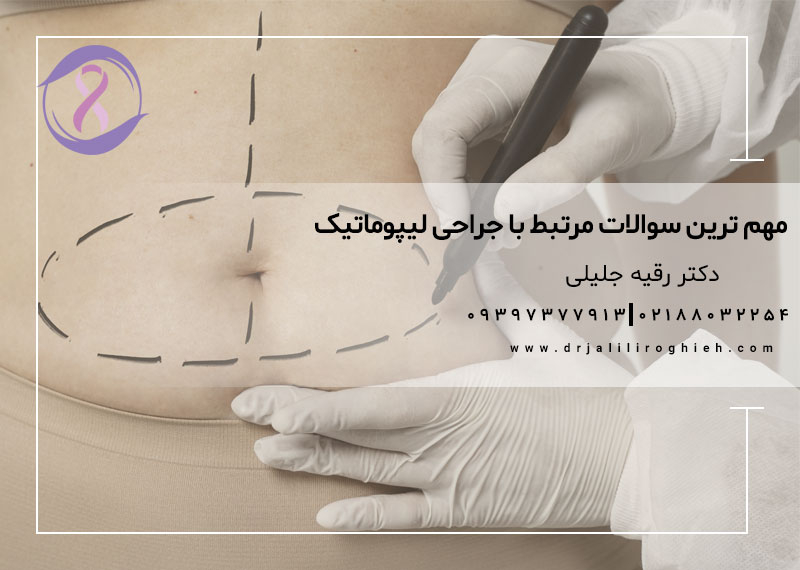 مهم ترین سوالات مرتبط با جراحی لیپوماتیک