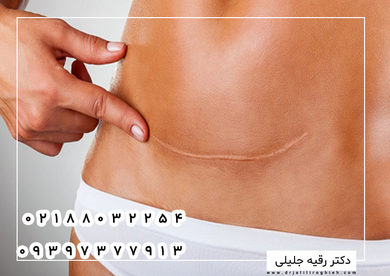 اقدامات لازم قبل از ابدومینوپلاستی