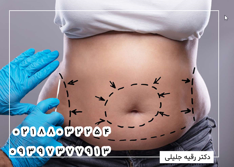 انواع جراحی زیبایی شکم
