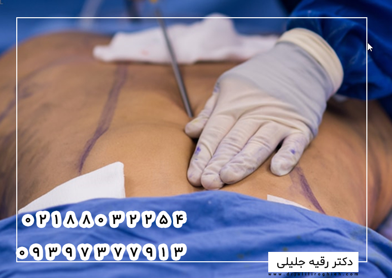 چه زمانی به ابدومینوپلاستی نیاز داریم؟