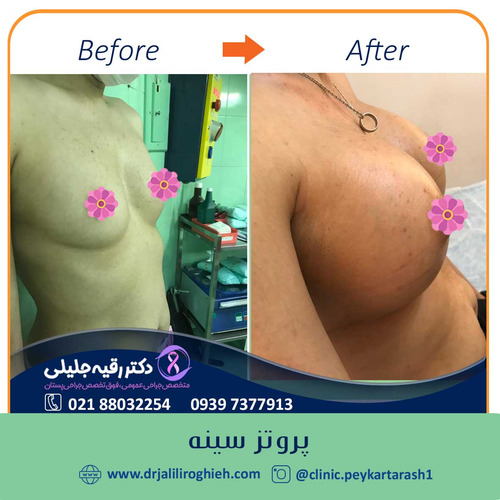 بهترین جراح سینه در تهران