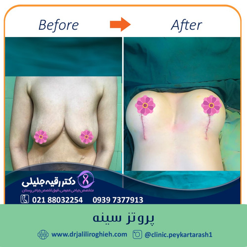 جراحی سینه در تهران