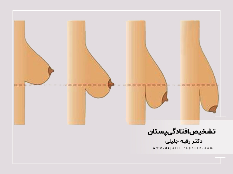 تشخیص افتادگی پستان