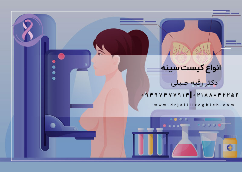 انواع کیست سینه