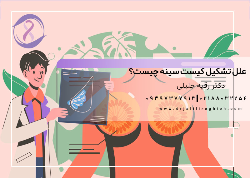 علل تشکیل کیست سینه چیست؟