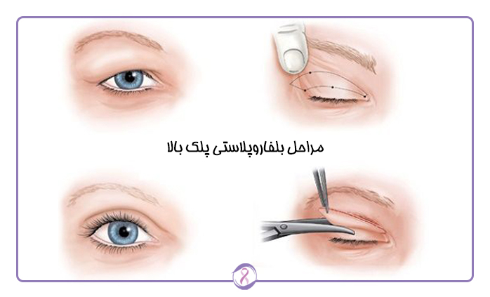 مراحل بلفاروپلاستی پلک بالا