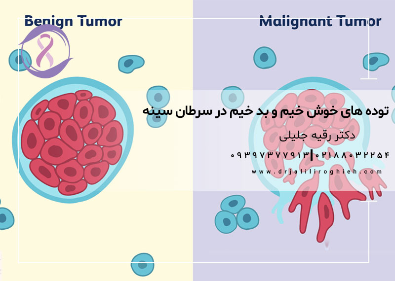 توده های خوش خیم و بدخیم در سرطان سینه