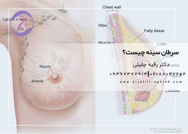 سرطان سینه چیست؟