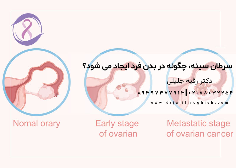 سرطان سینه، چگونه در بدن فرد ایجاد می شود؟