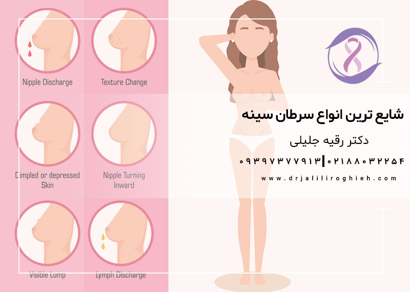 شایع ترین انواع سرطان سینه