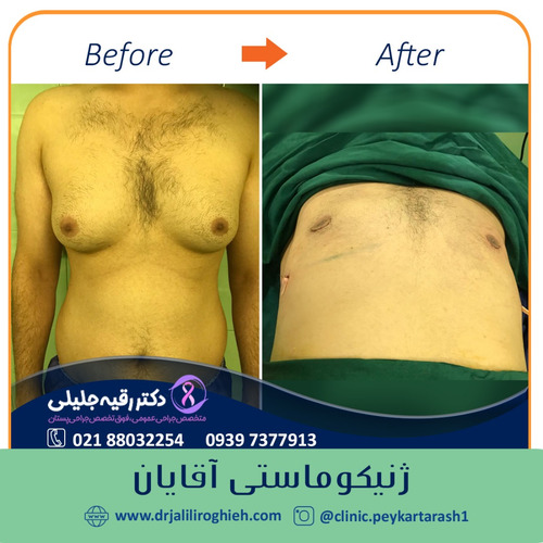 نمونه کار ژنیکوماستی