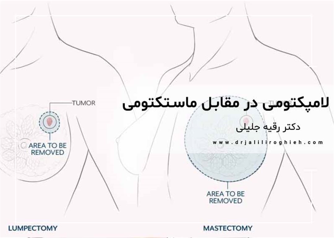 لامپکتومی در مقابل ماستکتومی | سرطان سینه