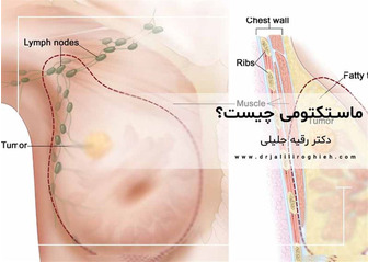 ماستکتومی چیست؟