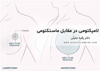 لامپکتومی در مقابل ماستکتومی | سرطان سینه