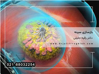 بازسازی سینه