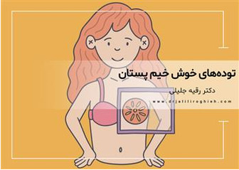 توده های خوش خیم پستان