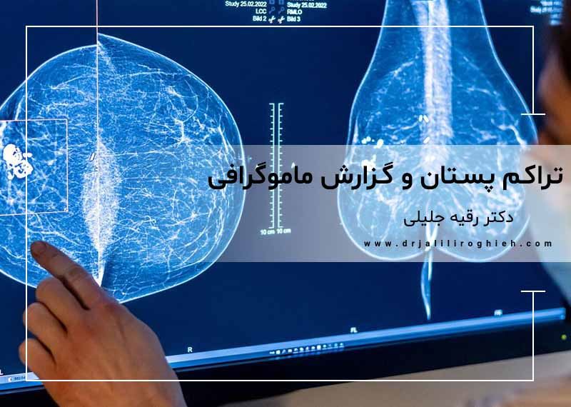 تراکم سینه و ماموگرافی | معنی BI-RADS و قدم بعدی
