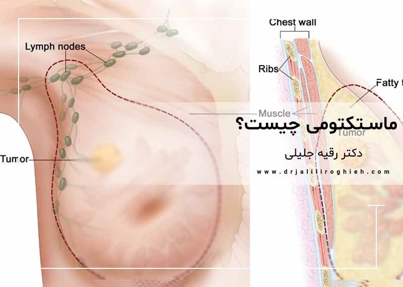 ماستکتومی چیست؟