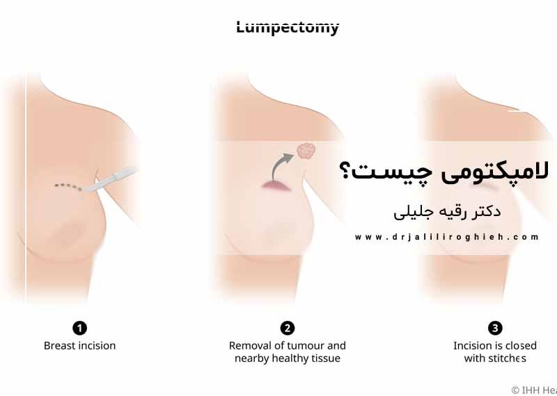 لامپکتومی چیست؟