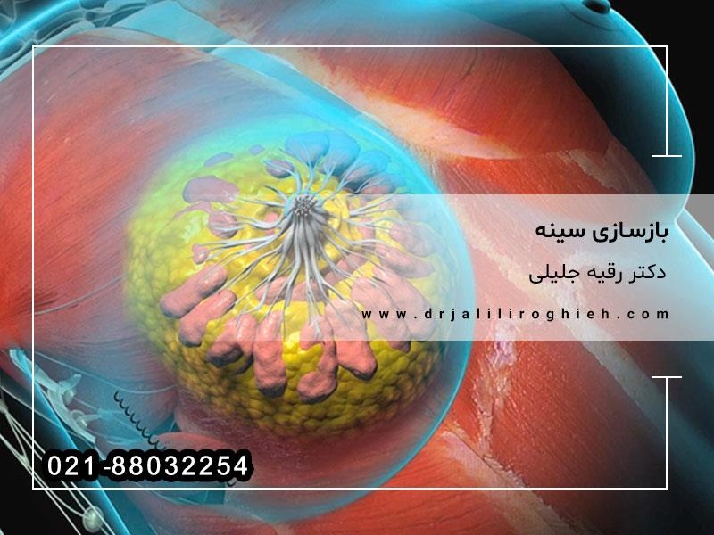 بازسازی سینه توسط دکتر رقیه جلیلی