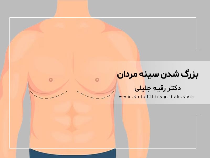 بزرگ شدن سینه مردان یا ژنیکوماستی