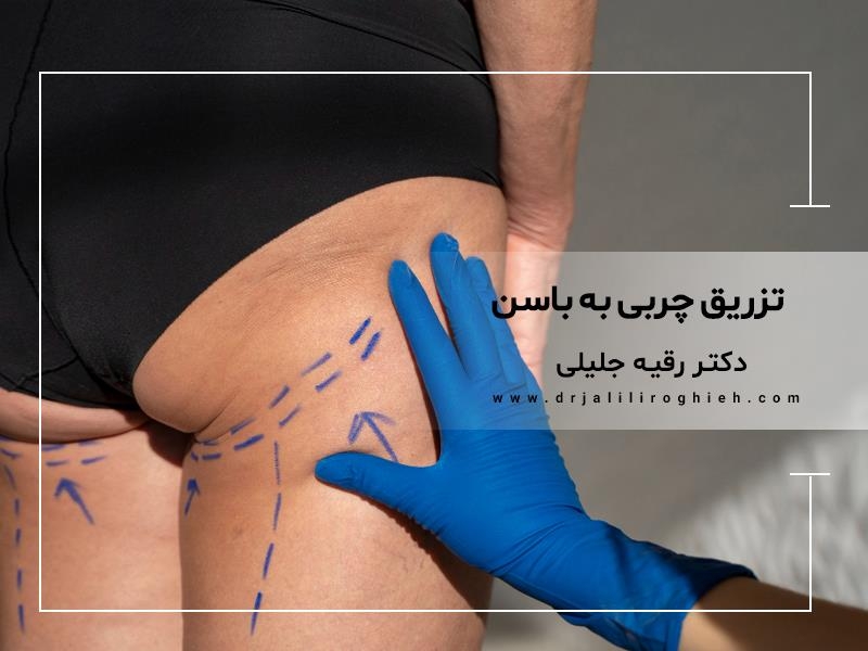 تزریق چربی به باسن | دکتر متخصص لیپوماتیک در تهران