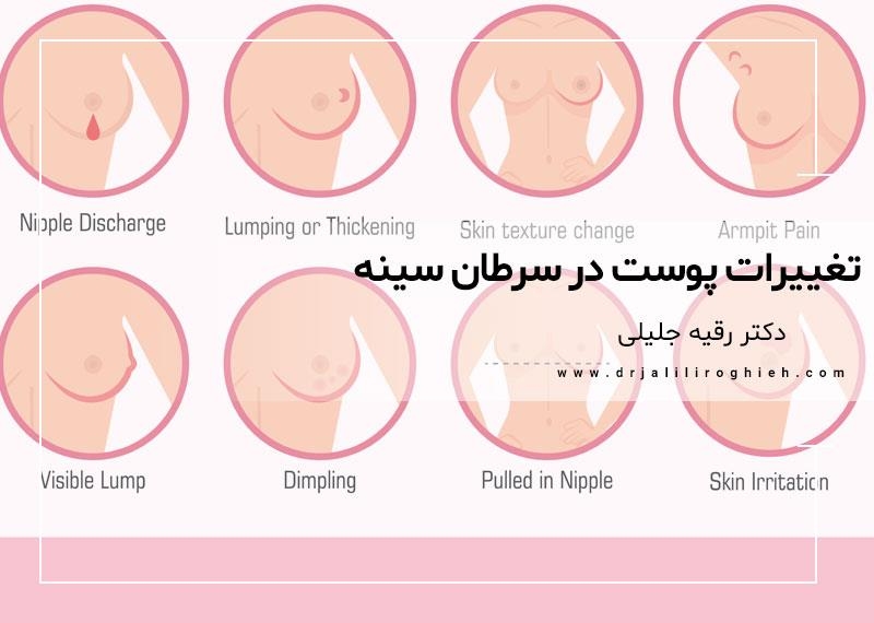 تغییرات پوست در سرطان سینه چگونه است
