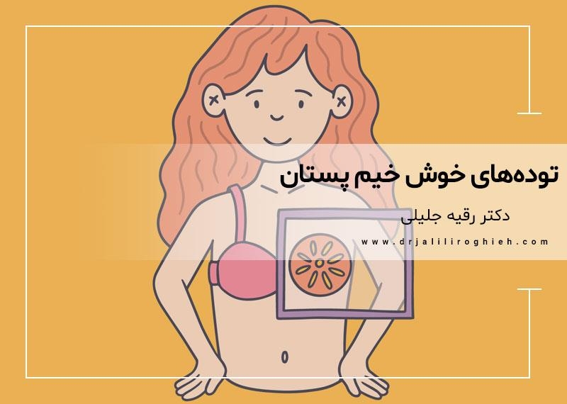 توده های خوش خیم پستان