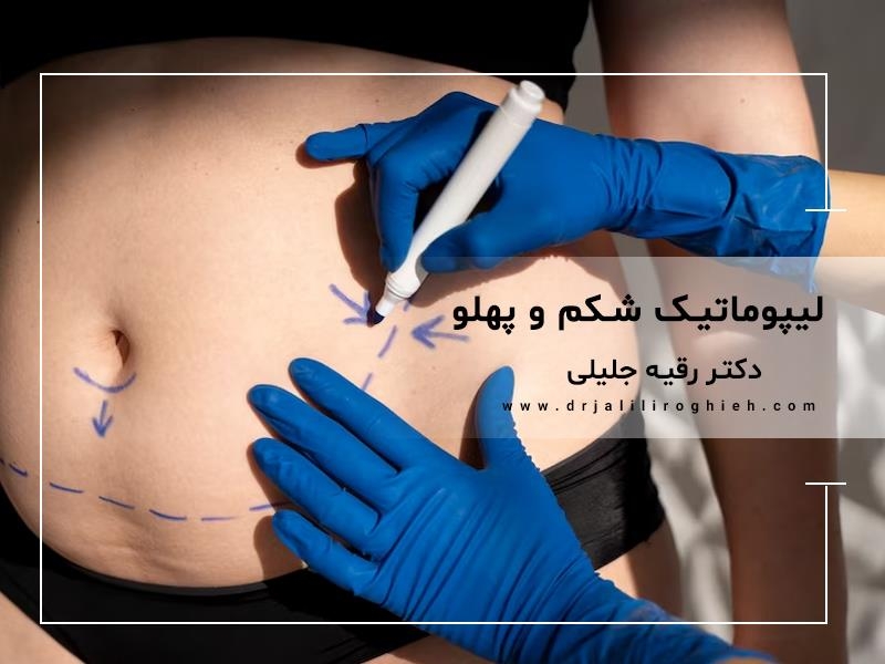 بهترین دکتر لیپوماتیک شکم و پهلو در تهران