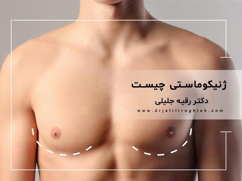 ژنیکوماستی (بزرگ شدن سینه مردان) چیست ؟