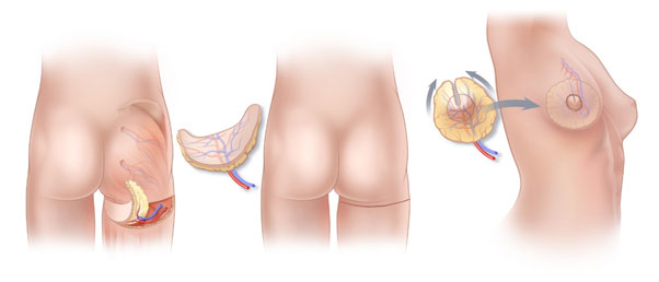 بازسازی سینه از طریق روش جراحی فلپ