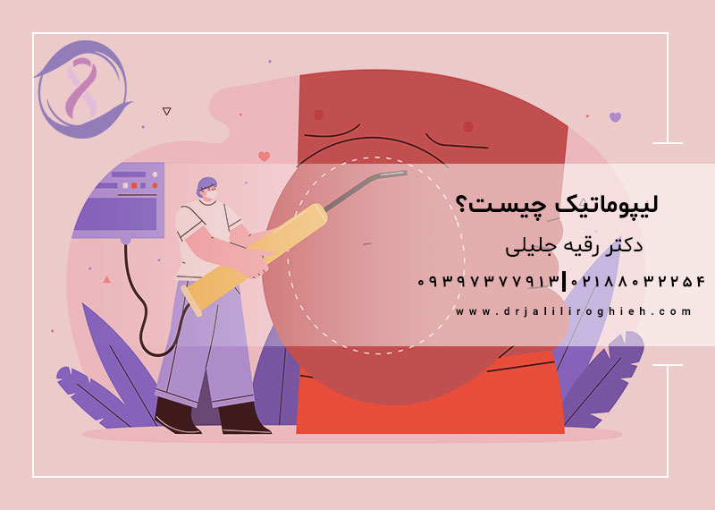 لیپوماتیک چیست