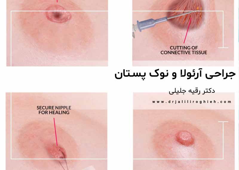 جراحی آرئولا و نوک پستان