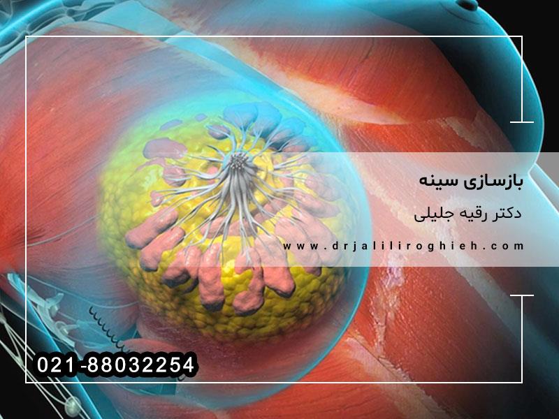 بازسازی سینه
