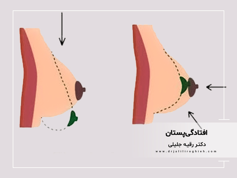افتادگی پستان