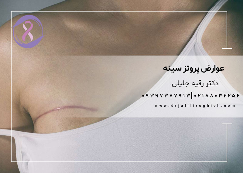 عوارض پروتز سینه