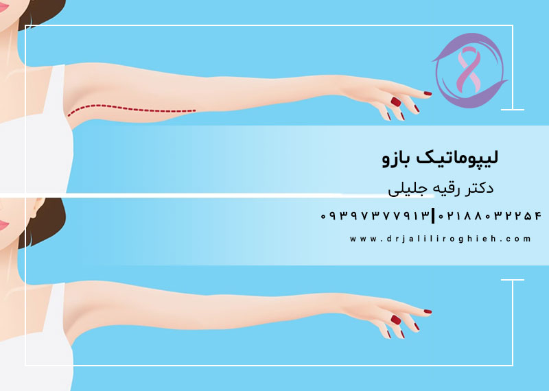 لیپوماتیک بازو در تهران